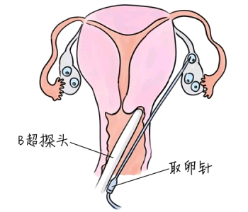 黄体酮注射液用法是什么 有哪些注意事项